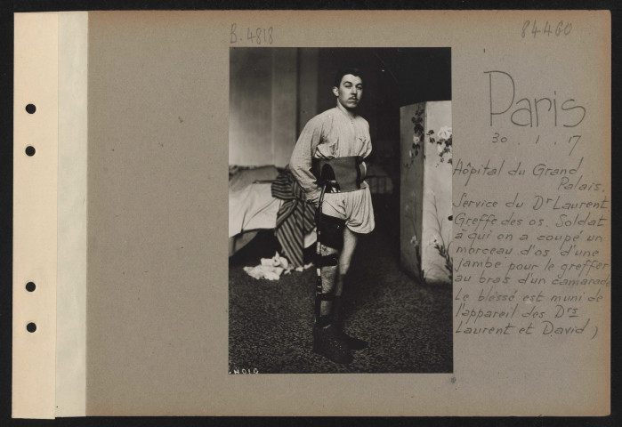 Paris. Hôpital du Grand Palais. Service du docteur Laurent. Greffe des os. Soldat à qui on a coupé un morceau d'os d'une jambe pour le greffer au bras d'un camarade. Le blessé est muni de l'appareil des docteurs Laurent et David