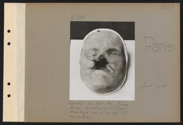 Paris. Hôtel du Val de Grâce. Musée anatomoclinique. Moulages en cire du docteur Morestier